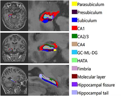 Altered Hippocampal Subfields Volumes Is Associated With Memory Function in Type 2 Diabetes Mellitus